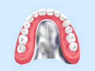 自費診療の入れ歯のイメージ画像