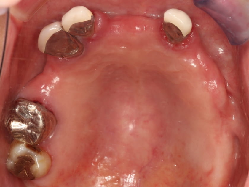 インプラント5本の治療前